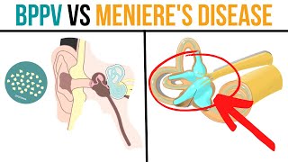 BPPV vs Menieres Disease Whats the Difference amp How to Improve [upl. by Aihseken]