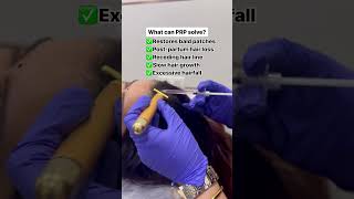 Hair growth with PRP  Welona Clinic Chennai [upl. by Dnalram]