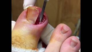 Chronic Ingrown Toenail with pyogenic granuloma formation [upl. by Emily]