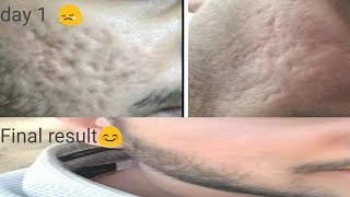 Dermabrasion treatment in hindi । India [upl. by Laktasic]