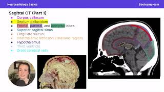 Neuroradiology Basis  Radiology  Med School Bootcamp [upl. by Antebi632]