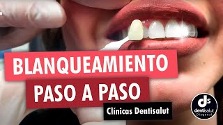 🦷😁 Blanqueamiento dental PASO A PASO 😁🦷 Antes y después  Clínica Dental Dentisalut [upl. by Kathe701]