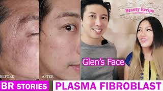 What is Plasma Fibroblast Skin Tightening Treatment in detail [upl. by Clarita]