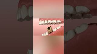 Losing molar tooth 3D animation dentist health [upl. by Airalednac461]