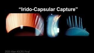 Alan Crandall MD 2020 ASCRS Winning Video  New Pupil Expander Used for Capsular Bag Support [upl. by Ledoux]