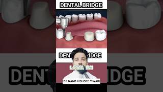 Dental BRIDGE procedure  Dental BRIDGE kaise BANTA HAI ❓shorts dental [upl. by Latreese194]