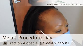 Hair Transplant Forehead Reduction Procedure for Traction Alopecia  Dr Matt Huebner Mela [upl. by Koral655]