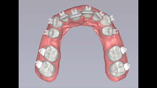 LightForce Braces  Clear 3D Printed Brace [upl. by Farrison]