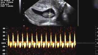 8 weeks 2 days Ultrasound Heartbeat [upl. by Nabi]