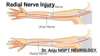 Radial nerve Injury Neuropathy Wrist Drop Hand Drop Causes Symptoms Diagnosis [upl. by Ruggiero441]