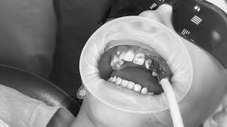 Impacted tooth extraction [upl. by Hanover166]