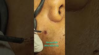 Mole Removal by Radio Frequency Ablation [upl. by Nomis]