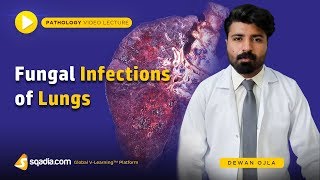 Fungal Infections of Lungs  Pathology Lectures  Medical Education Videos  VLearning [upl. by Anotyal]