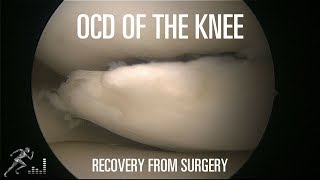 How long does it take to recover from surgery for an OCD lesion of the knee [upl. by Certie489]