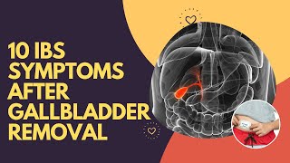 10 IBS Symptoms After Gallbladder Removal [upl. by Ki]