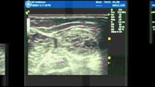 Ultrasound Guided ankle block part 1 [upl. by Letha935]