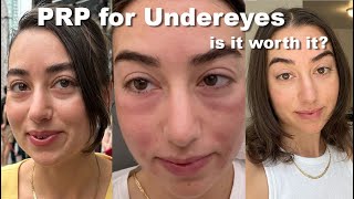 Trying Under Eye PRP Injections for the First Time [upl. by Flem]