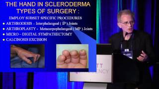 2013 Atlanta  The Hand In Scleroderma Surgical Options  Dr Charles Melone [upl. by Bara]