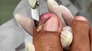 Ingrown Toenail Removal 👣 Take Care of Your Toenail Pain at Home Ingrown Pedicure [upl. by Yrgoerg572]