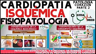 CARDIOPATÍA ISQUÉMICA FISIOPATOLOGÍA  GuiaMed [upl. by Kcitrap]