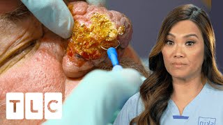 Dr Lee Transforms Patients Hugely Overgrown Nose I Dr Pimple Popper Pop Ups [upl. by Atena93]