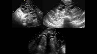 Chest FRCR2b CASES [upl. by Lap]