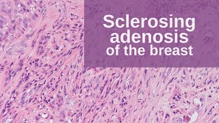 Sclerosing Adenosis of the Breast  Pathology mini tutorial [upl. by Goodyear]