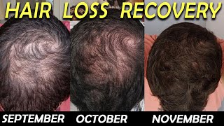 3 Month Hair Loss Reversal with Dutasteride Minoxidil and Saw Palmetto [upl. by Ahsimot]