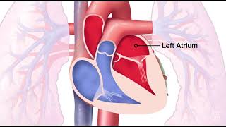 Mitral Valve Regurgitation [upl. by Stine]