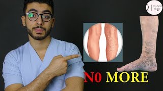 ما هى دوالى الساقين ؟  علاج مشكلة الدوالى نهائيا varicose veins treatment [upl. by Ardnasal948]