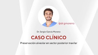 Caso clínico Preservación alveolar en sector posterior alveolar  Dr Sergio García Moreno [upl. by Lauryn]