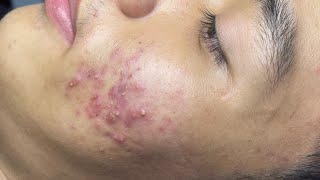 ACNE TREATMENT VU QUYNH MI  Blackheads Of Tweens 2024 EX [upl. by Aihtennek]