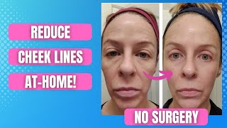 Smooth and Youthful Minimize MidCheek Lines With These Effective AtHome Remedies [upl. by Kanal683]