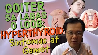 Goiter sa Labas o Loob Hyperthyroid Sintomas at Gamot  Payo ni Doc Willie Ong 212 [upl. by Dmitri]