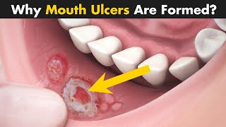 Mouth Ulcers  Mouth Ulcers Symptoms Causes And Treatment  Demystifying science [upl. by Damiani]