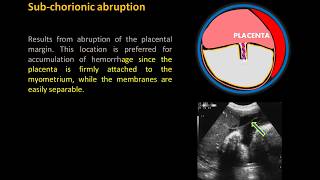 Ultrasound Imaging of Placental Abruption [upl. by Paehpos]