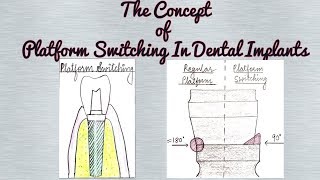 Platform Switching in Dental Implants Crestal Bone Loss around Dental Implants [upl. by Garrik183]