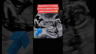 Side effects vaping baby painful movements in pregnancy🥲🥲viralvideo trending baby [upl. by Immak639]