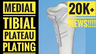 Medial Approach and Plating of Medial Tibial Condyle [upl. by Wivinia787]