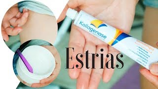 🔥 Usando KOLLAGENASE  ÓLEO DE GIRASSOL para tratar estrias FÓRMULA do creme no 1° comentário [upl. by Asenab]