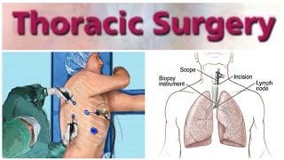 Thoracic Surgery 1  Bronchogenic Carcinoma [upl. by Ardnuahc727]