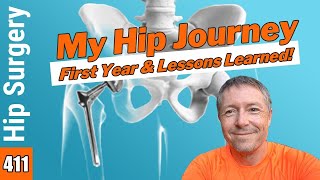 Total Hip Replacement monthly progress and LESSONS LEARNED [upl. by Akirrehs]