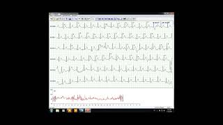 Analysis For HOLTER 48 Hours Software In English By Eng Mohamed El Ashry [upl. by Tlihcox]