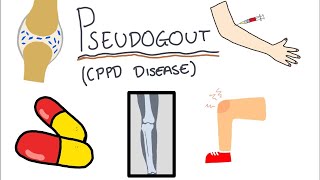 Pseudogout Calcium Pyrophosphate Disease  Simple and easy to understand [upl. by Hauger]