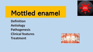 Mottled enamel  Oral pathology  Enamel hypoplasia due to fluoride [upl. by Iris]