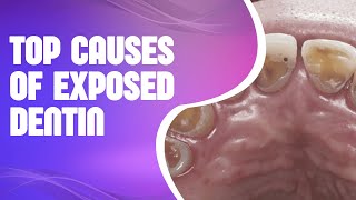 Top Causes of Exposed Dentin Signs Symptoms and Treatments [upl. by Heddi825]