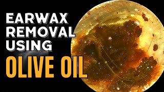 Painstaking Earwax Removal Using Olive Oil [upl. by Stanwin654]