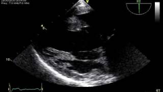 3 RUPTURE CHORDAE TRANSGASTRIC TOE VIEW MITRAL REGURGITATION [upl. by Enileuqkcaj]