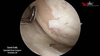 What Does Arthritis of The Knee Joint Look Like [upl. by Nuawaj]