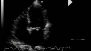 calcific aortic stenosismitral annular calcification and flail mitral valve 22 [upl. by Mellar343]